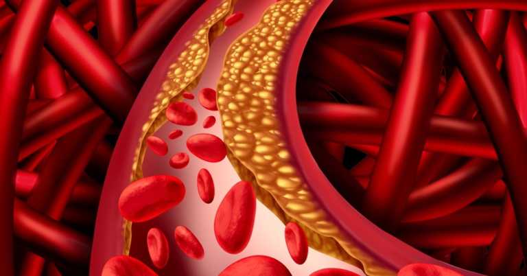 5 Natural Tips For Lowering Cholesterol