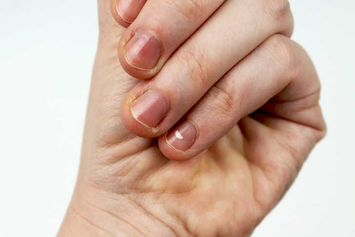 What Are Your Nails Trying To Tell You About Your Health 12 Tomatoes