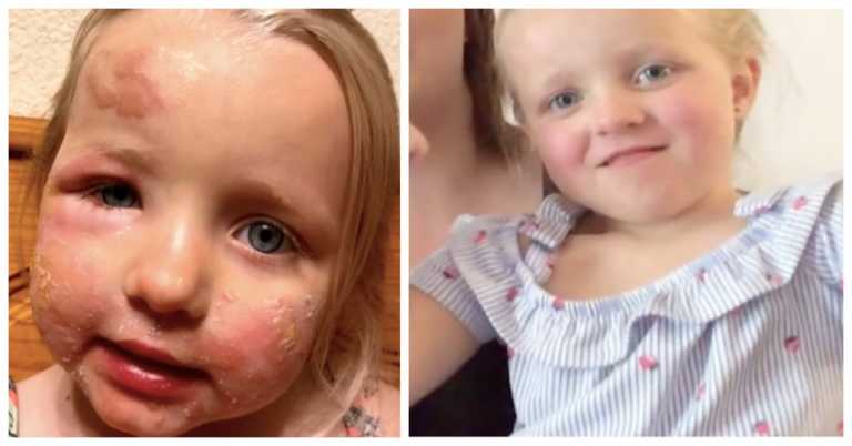 Mom Warns Others After Little Girl’s Skin Blisters From ‘Margarita Burn’