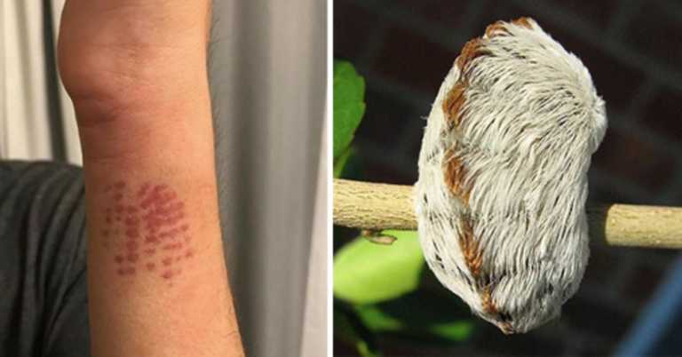 Mom Is Warning Other Parents After Her Son Was Bit By A Venomous Caterpillar