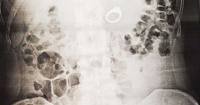 Woman Dreamt That She Swallowed Her Engagement Ring, Wakes Up To Learn She Actually Did