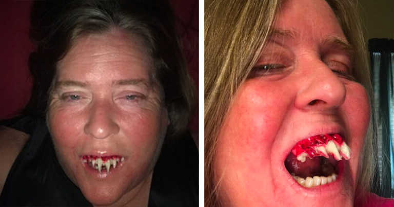 Woman’s Warns Others After Her Halloween Fangs Got Stuck To Her Real Teeth
