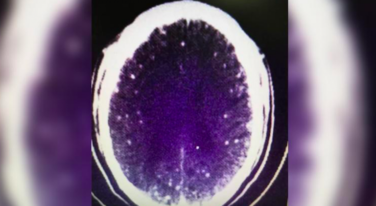 Undercooked Pork May Be To Blame After Doctors Find Hundreds Of Tapeworms In A Man’s Brain