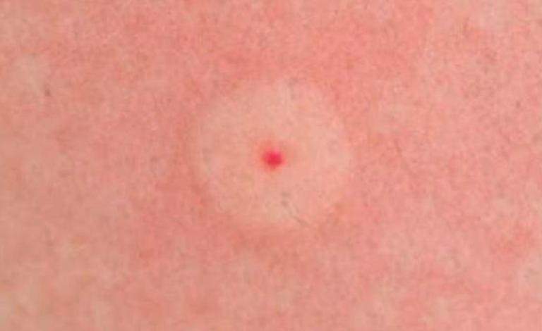 How To Recognize The 10 Most Common Insect Bites