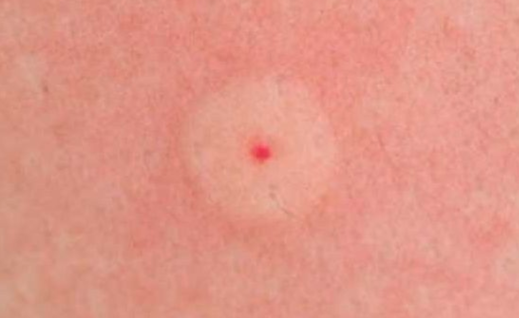 small red bug bites that itch