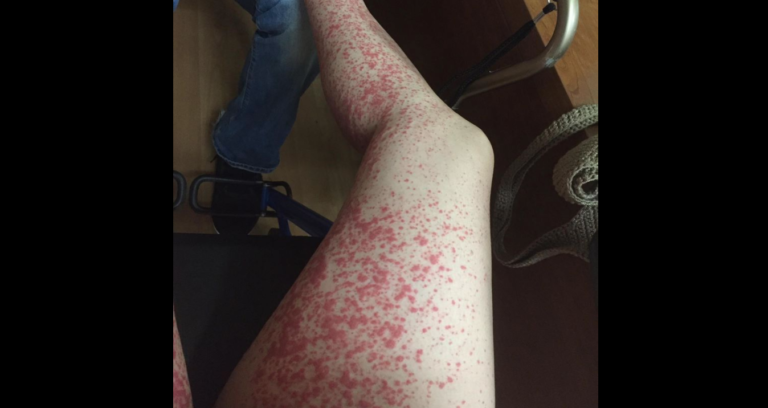 Beware Of Ticks When Visiting Your Local Pumpkin Patch This Fall