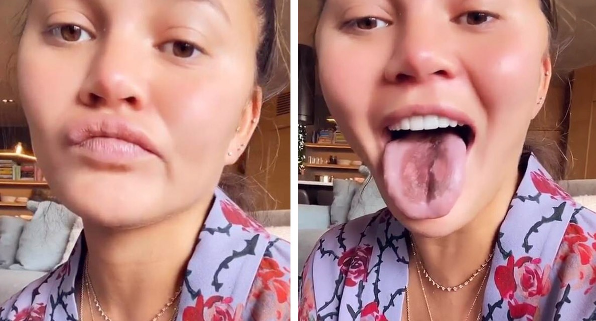 Chrissy Teigen’s Tongue “Peels Off” After Eating Too Much Sour Candy