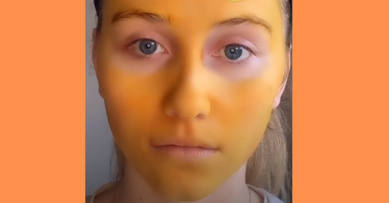 Girl Tries DIY Turmeric Face Mask And Stains Her Face Bright Orange