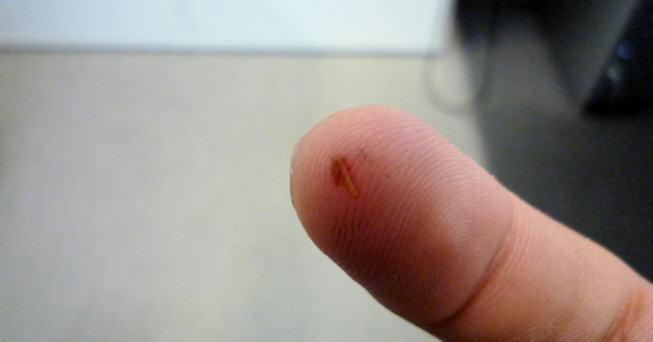 How To Remove Splinters Using A Syringe