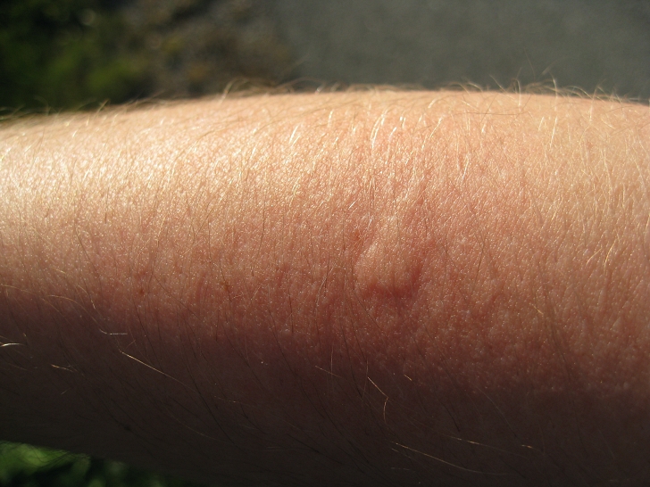 raised mosquito bite on arm