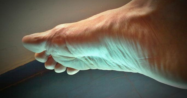 Woman Has Mysterious Burn After Spending The Day Drinking With Friends