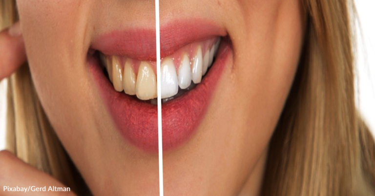Dentist Issues Warning After Dangerous Teeth-Whitening ‘Hack’ Goes Viral