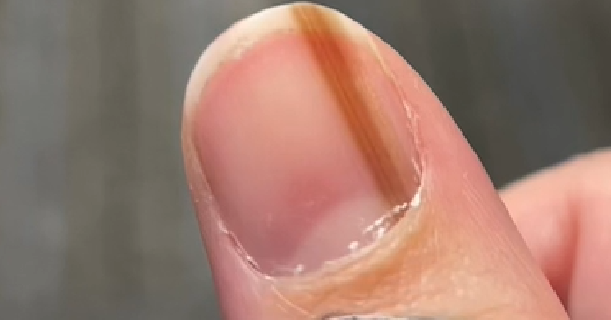 Woman warns black line down nail could be sign of cancer