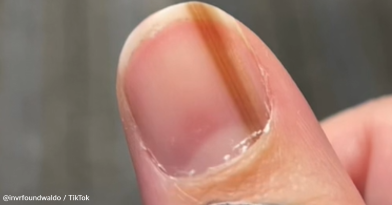 Woman Warns Why You Should Look Out For Brown Lines On Your Thumbnails