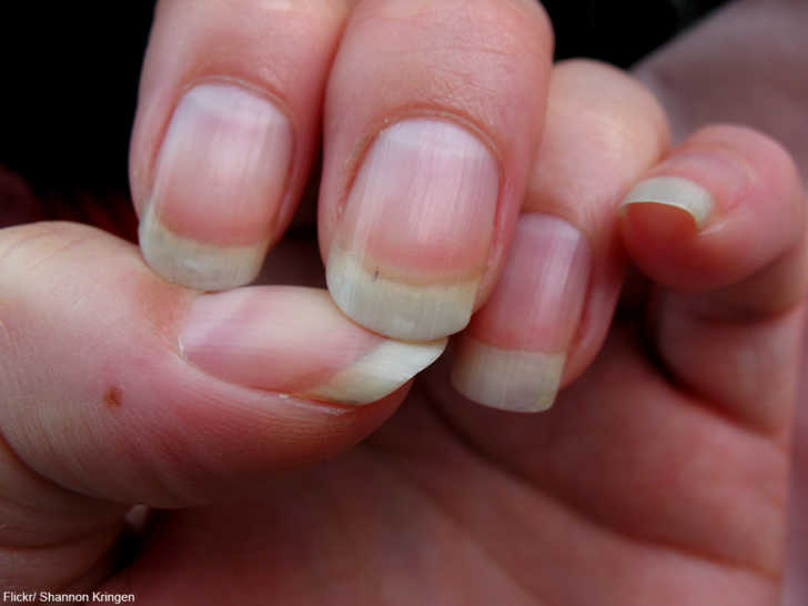 Diseases and Medical Disorders That Show Up In Your Nails First | Dusty Old  Thing