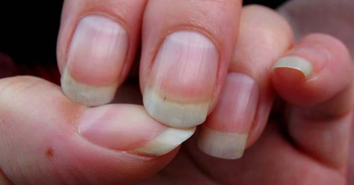 Diseases and Medical Disorders That Show Up In Your Nails First | Dusty Old  Thing