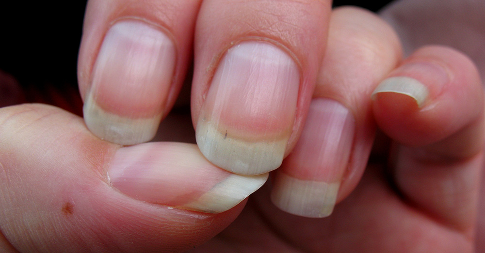 Diseases and Medical Disorders That Show Up In Your Nails First Dusty