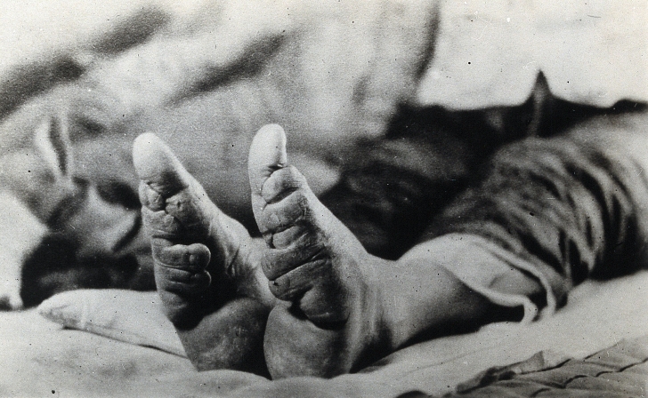 photo of bound feet
