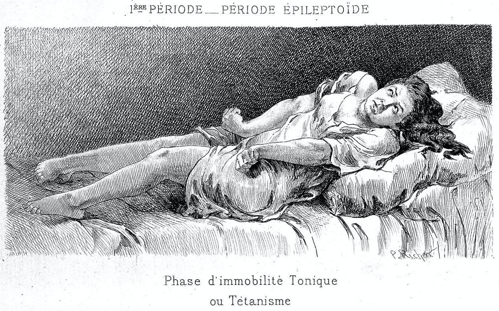 1800s engraving of a tetanus patient