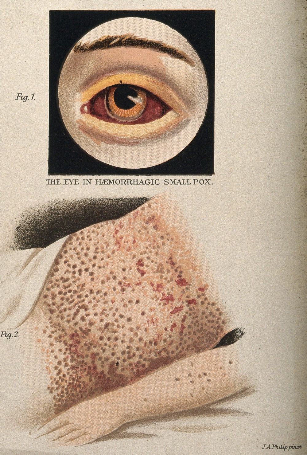 1900 illustration of smallpox symptoms
