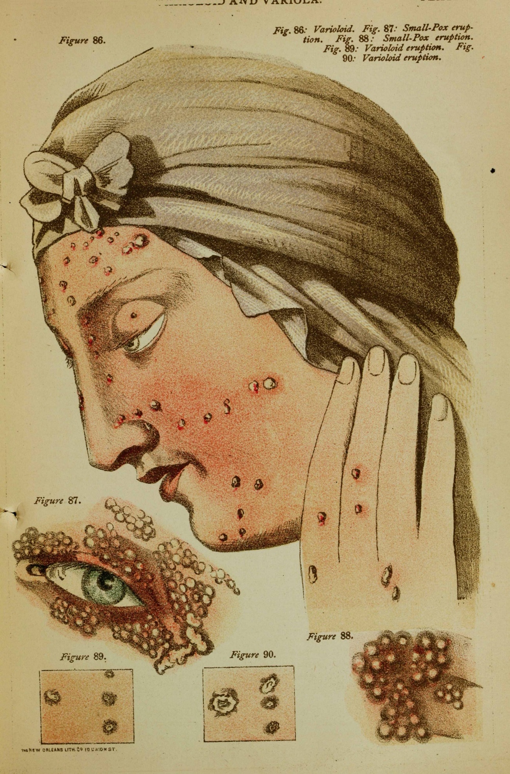 19th century medical illustration of different types of pox
