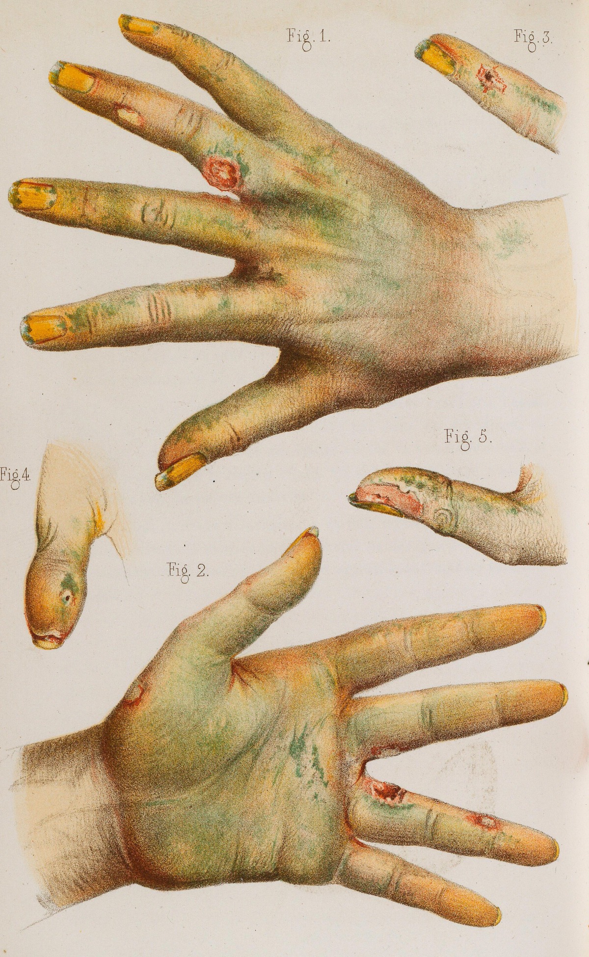 19th century drawing of hands damaged by arsenic green