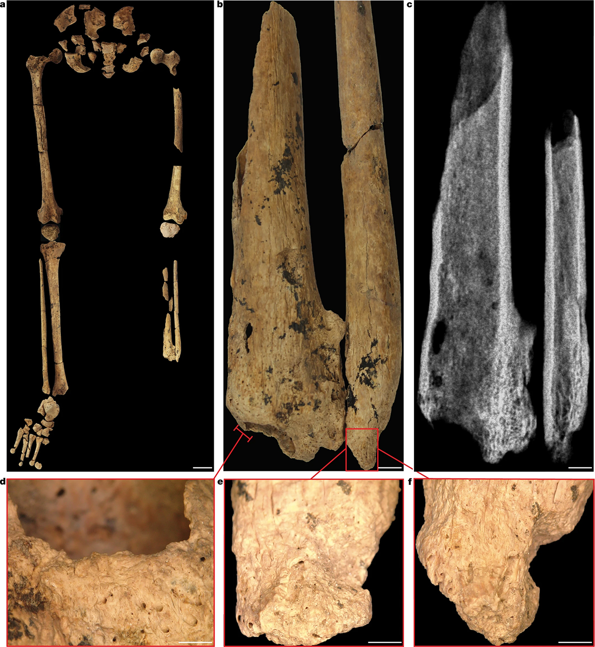 skeletal remains showing ancient amputation in Borneo