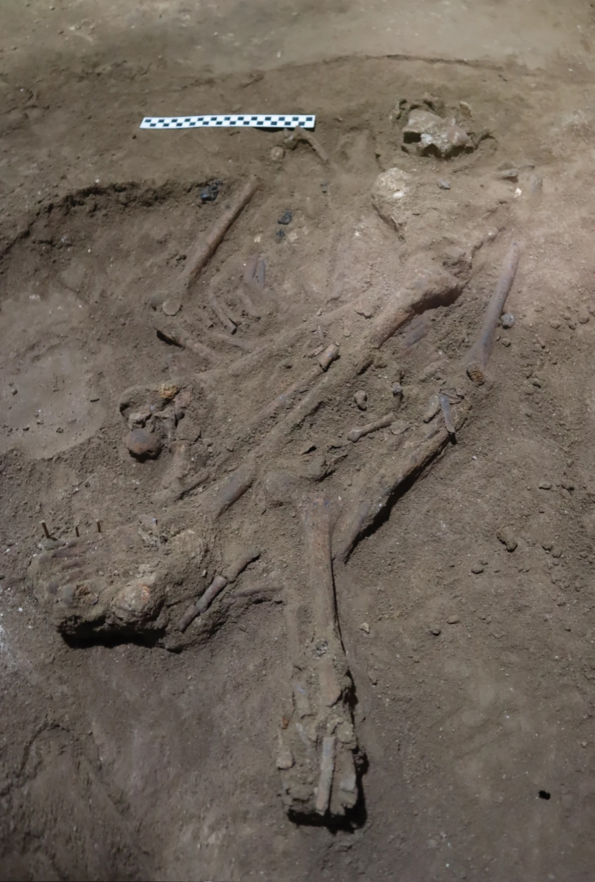 skeletal remains showing ancient amputation in Borneo