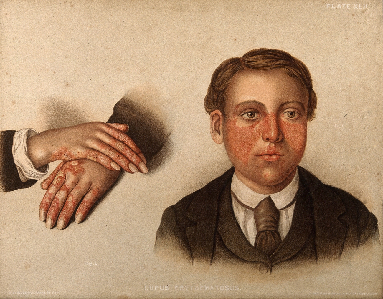 Medical Drawings of Lupus Rash from the 1800s