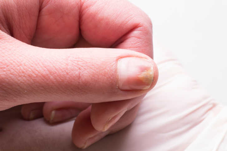 From arthritis to anaemia... what your fingernails could tell you about  your health | The US Sun